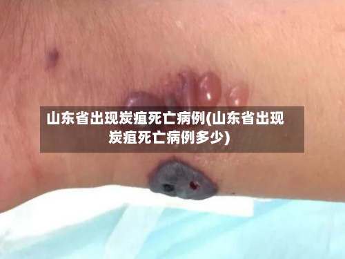 山东省出现炭疽死亡病例(山东省出现炭疽死亡病例多少)-第2张图片