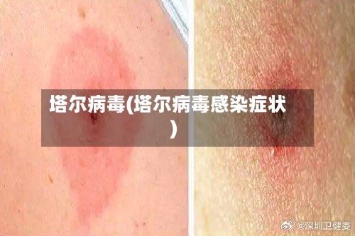 塔尔病毒(塔尔病毒感染症状)-第2张图片